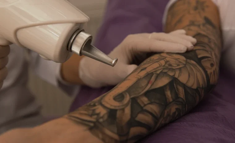 Laser Tattoo Removal slider