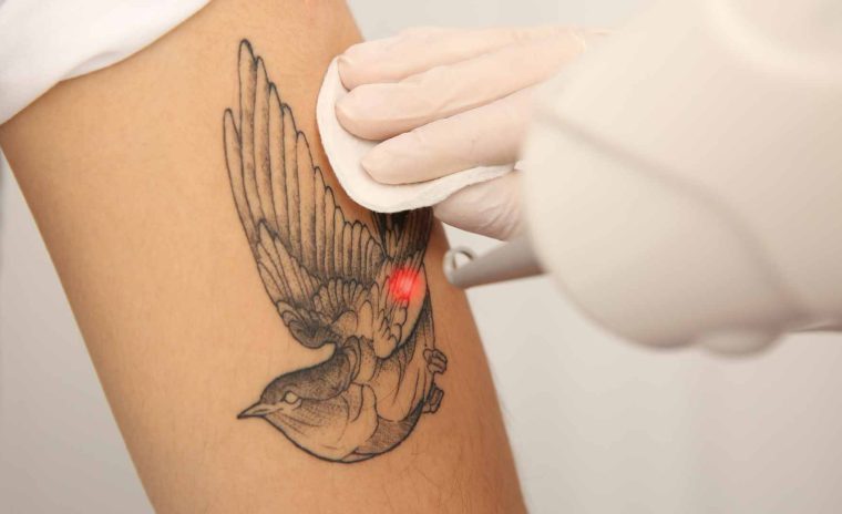 tattoo removal 1