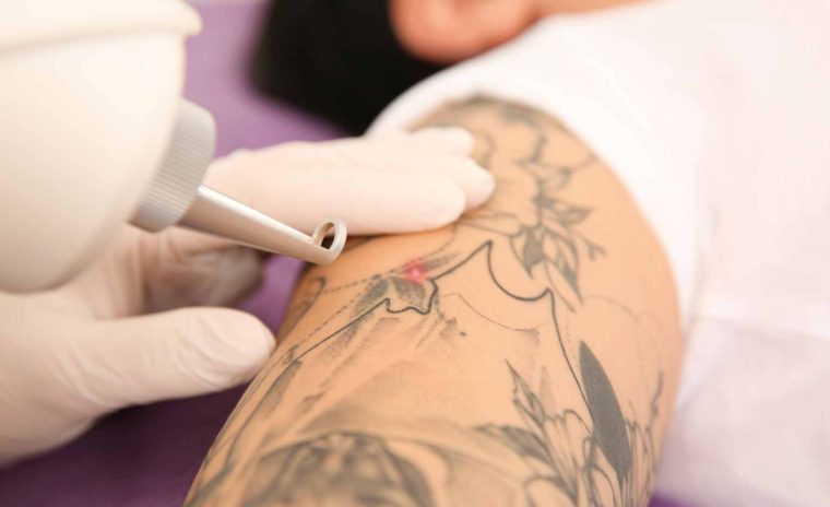 tattoo removal 2